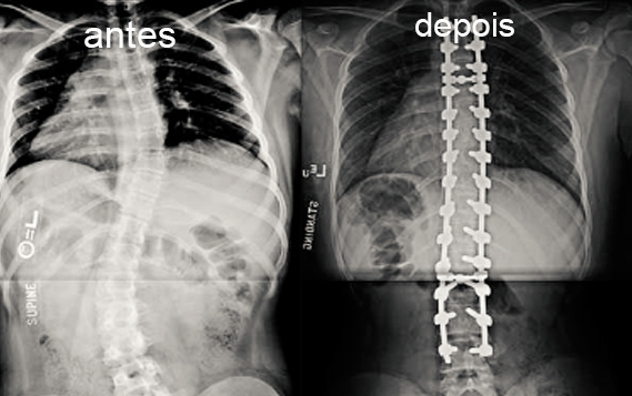 Radiografia de paciente com escoliose antes e depois do tratamento