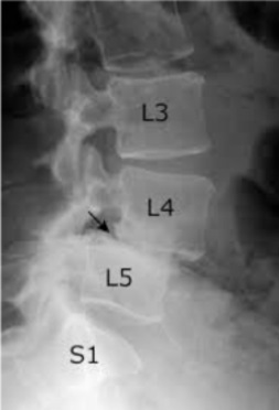 Radiografia apontando o deslizamento de uma vértebra
